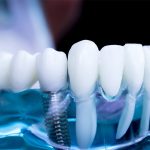 Bayrampaşa Diş İmplantı Sonrası Bakım - Polident Diş Polikliniği