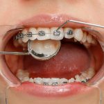 Diş Teli Kopması Durumunda Ne Yapılmalı? - Bayrampaşa Polident Diş Polikliniği