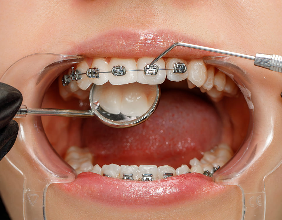 Diş Teli Kopması Durumunda Ne Yapılmalı? - Bayrampaşa Polident Diş Polikliniği