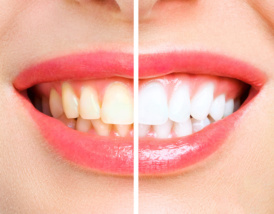 Bayrampaşa Diş Beyazlatma - Polident Diş Polikliniği