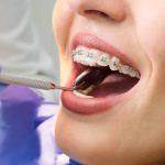 Bayrampaşa Ortodonti Tedavisi Süreci - Polident Diş Polikliniği