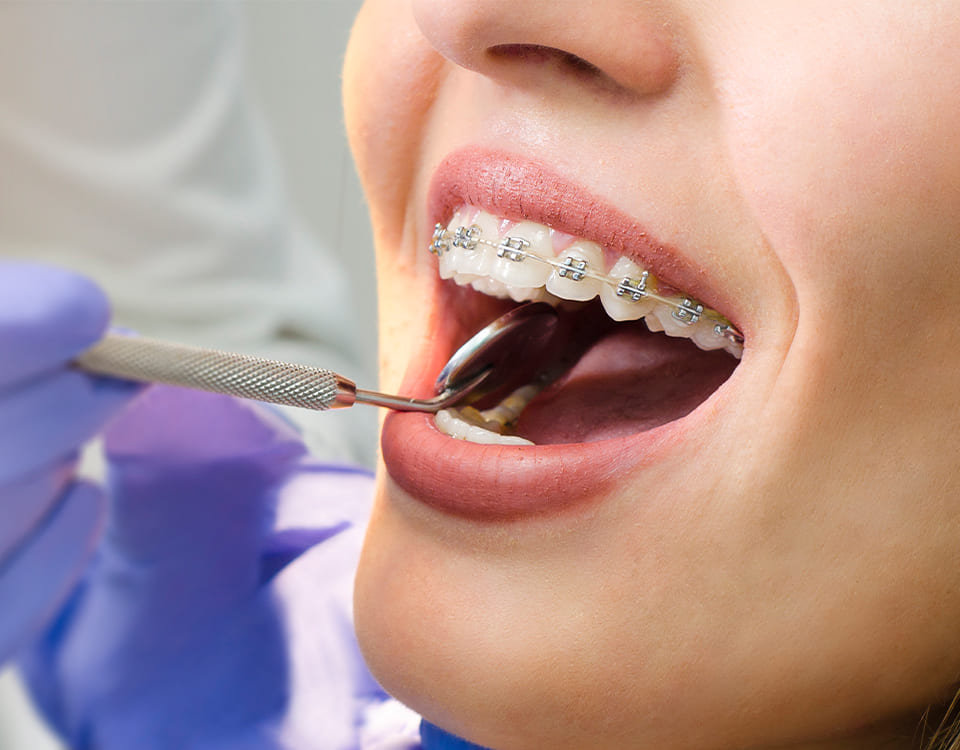 Bayrampaşa Ortodonti Tedavisi Süreci - Polident Diş Polikliniği