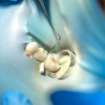 Eksik Dişler İçin Köprü Tedavisi - Polident Diş Polikliniği