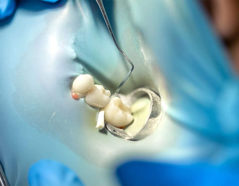 Eksik Dişler İçin Köprü Tedavisi - Polident Diş Polikliniği